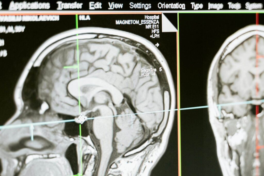 TBI effects