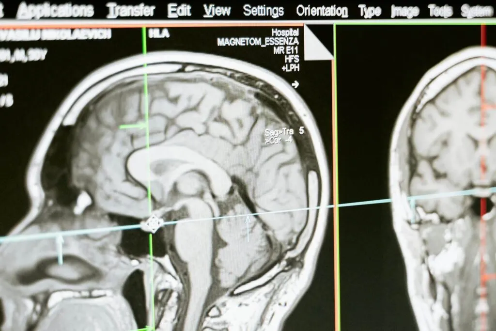 Average Settlement for Traumatic Brain Injury in New York