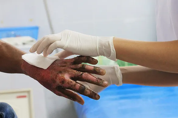 Burn injury being dressed by nurse